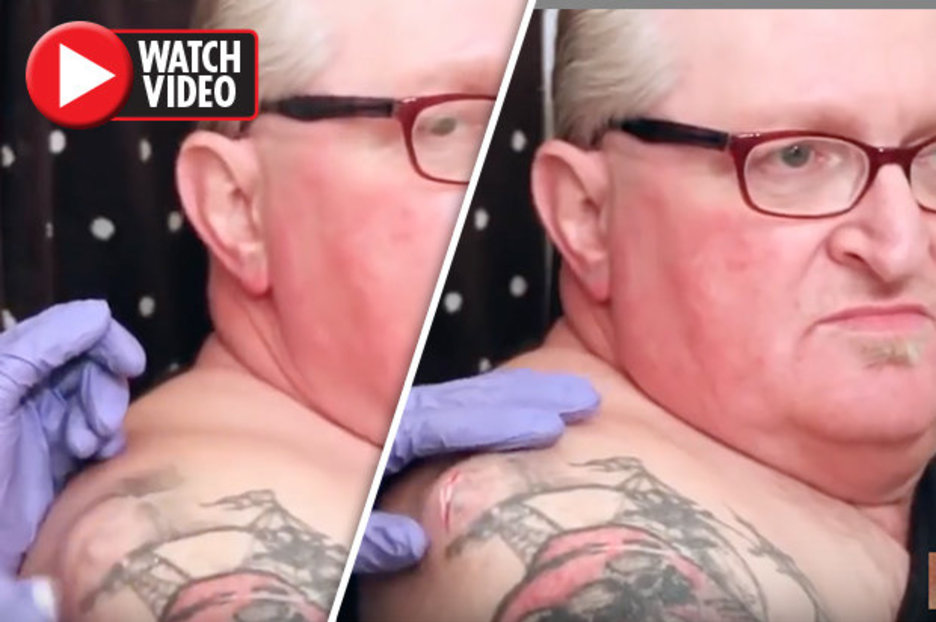 Cyst popping video: Man’s huge pimple spews pus ‘like cottage cheese’