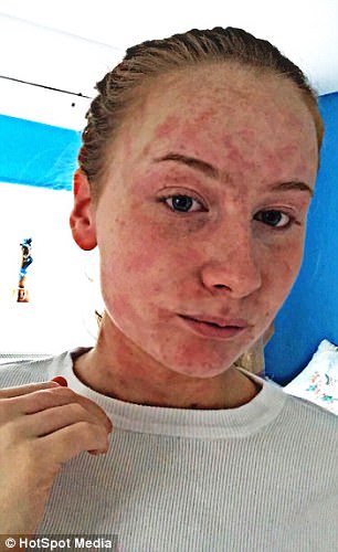 Devon teenager with ’embarrassing’ hives finds love