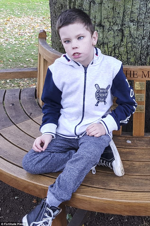 Boy, 9, will NEVER smile because of a rare condition