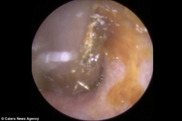 Neel Raithatha is able to hear after having earwax removed