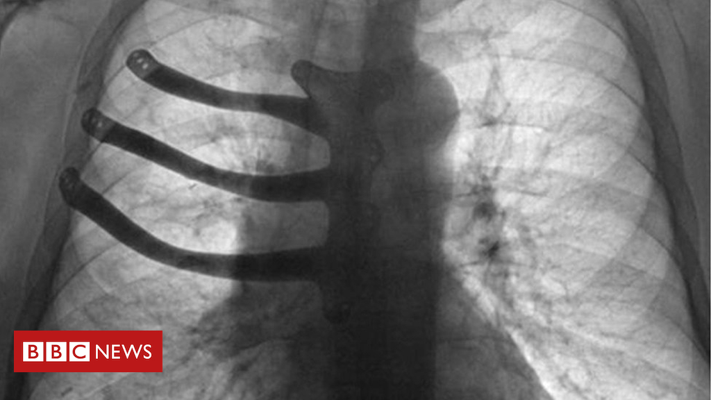 Patient’s chest rebuilt with 3D print after tumour surgery