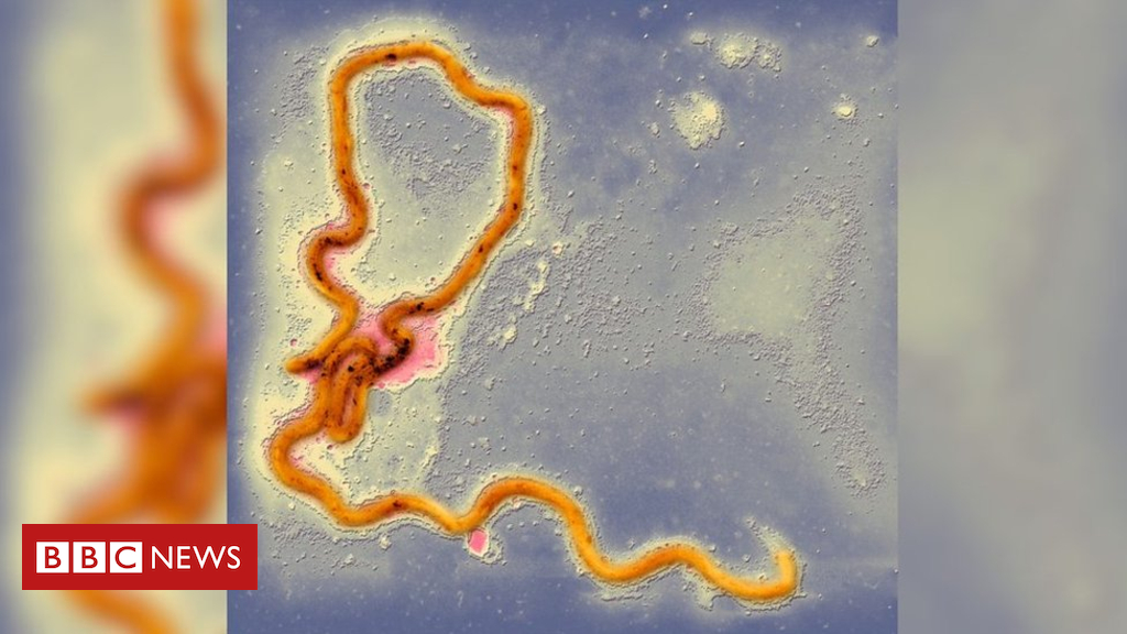 Syphilis patient calls for public debate as cases rise