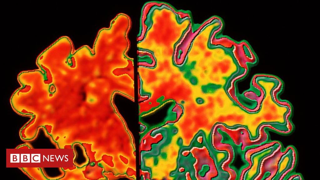 Brain injuries increase dementia risk, study finds
