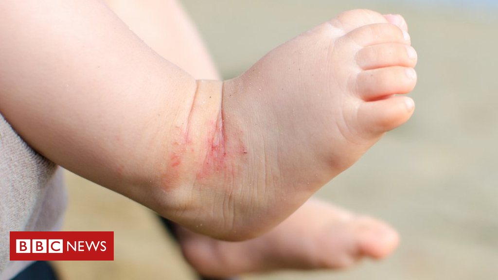 Bath additives for child eczema ineffective, study finds