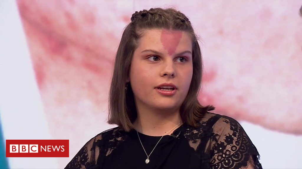 Mum helps stop daughter being bullied for birthmark
