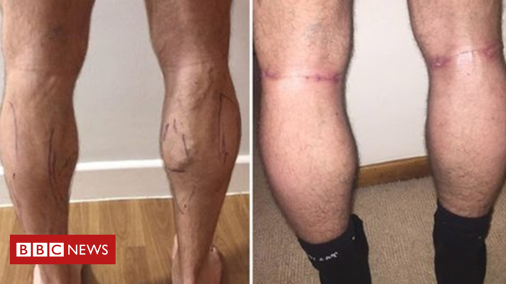 Why I got calf implants: 'There was no other option'