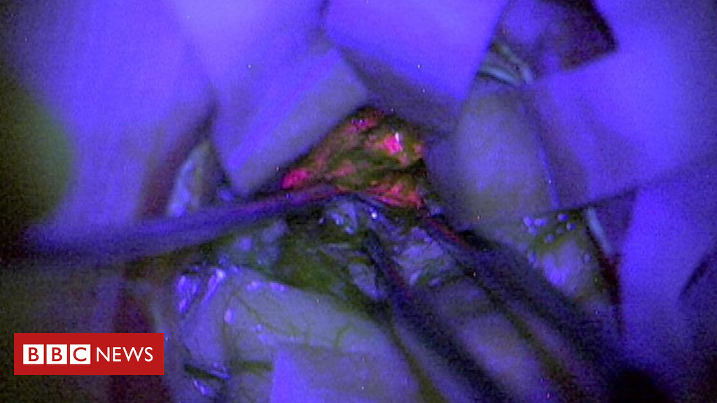 Glowing chemical ‘could aid brain cancer surgery’