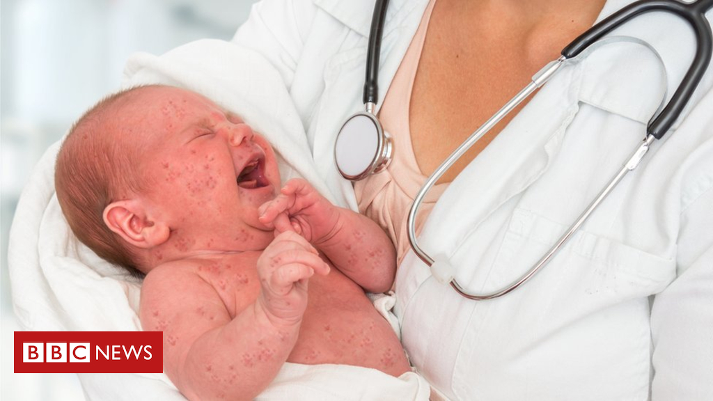 Measles resurgence ‘due to vaccine hesitancy’, WHO warns