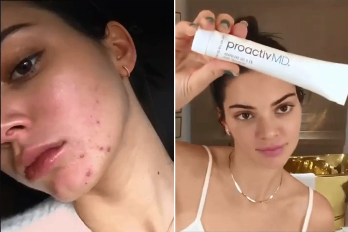Kendall Jenner is now a Proactiv spokesperson and fans are dismayed