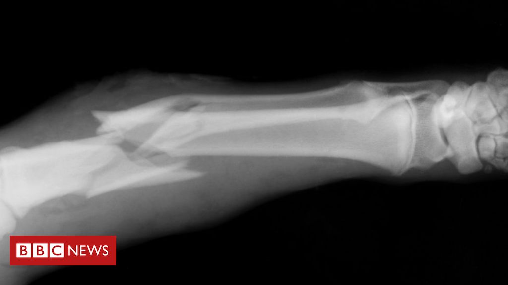 Fear wrong metal plates used to fix fractures