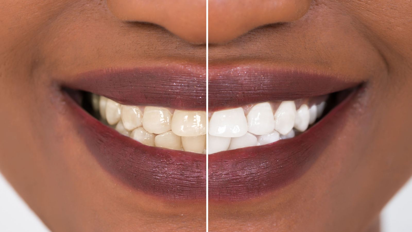 Consumers ‘gambling with their teeth’ by using whitening kits | UK News