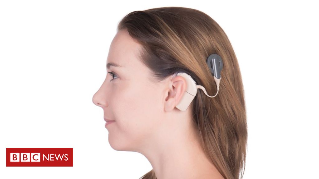 Cochlear implants to benefit more people with hearing loss