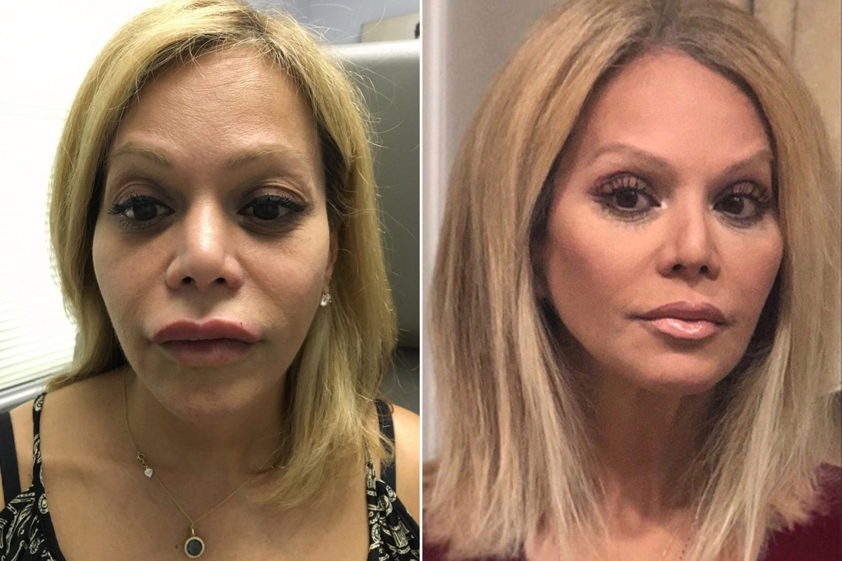 Why filler fanatics are suddenly scrambling to de-puff