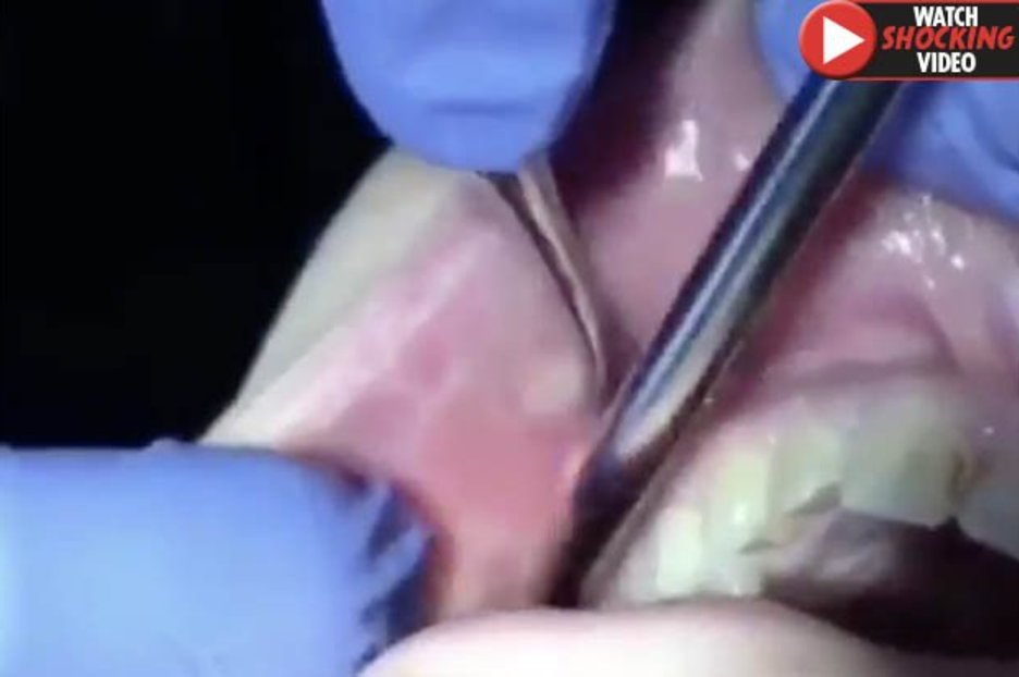 Cyst popping video: Mouth spot explodes leaving viewers throwing up