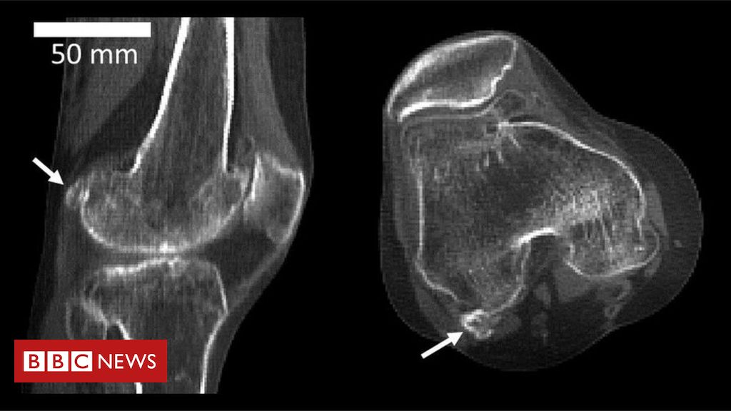 Sore knee? Maybe you have a fabella