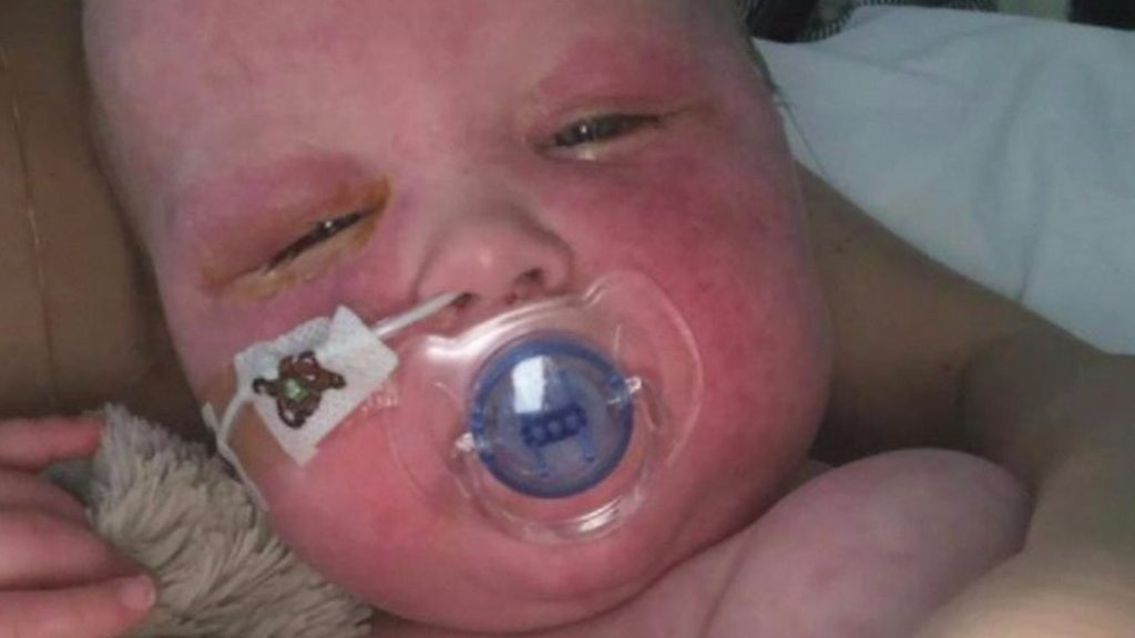 Measles: ‘My baby’s eyes were swollen shut’