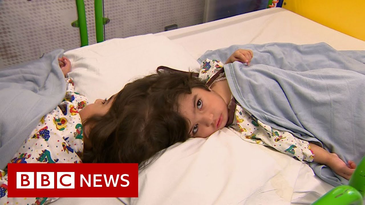 How doctors separate twins joined at the head – BBC News