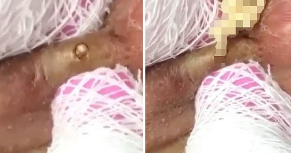 Cyst erupts with never-ending stream of ‘silly string’ pus in gruesome video