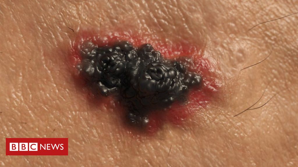 Skin cancer: Half of people surviving advanced melanoma