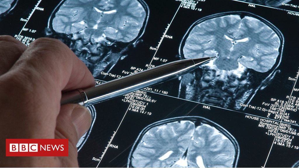 Dementia: New Alzheimer’s drug ‘could slow rate at which disease progresses’