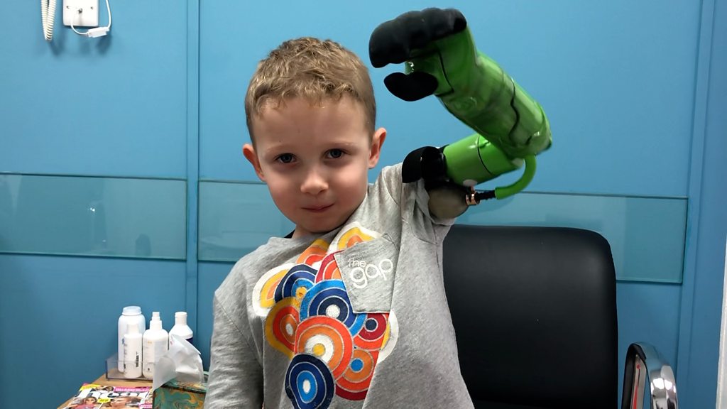 Boy, 5, given prosthetic arm that lets him hug brother