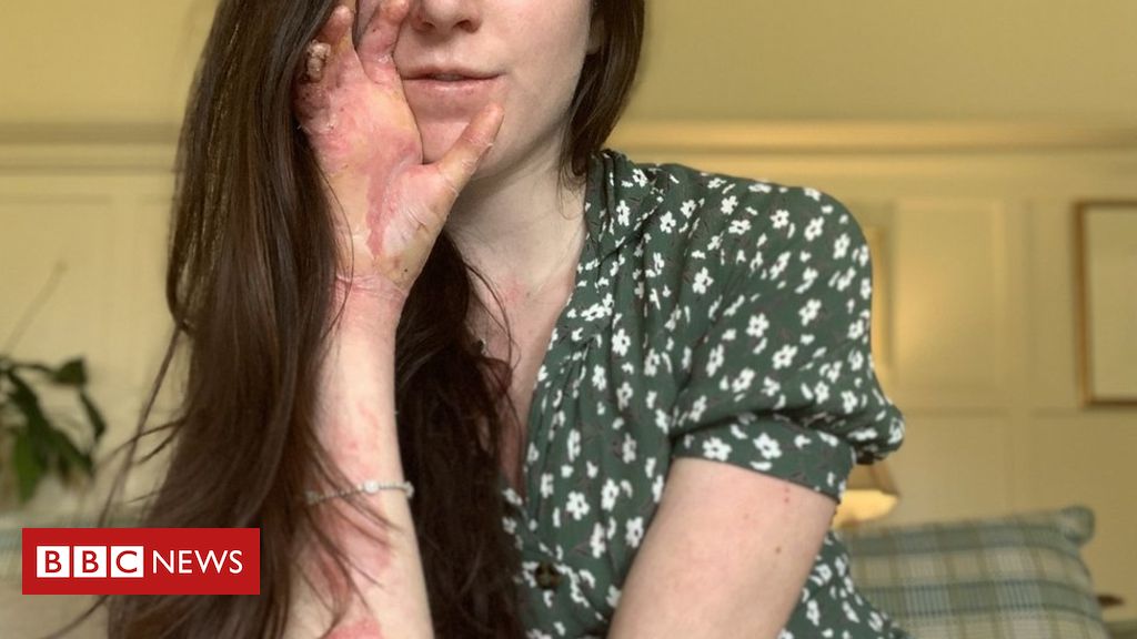 My ‘butterfly skin’ could kill me but I want to raise awareness for others