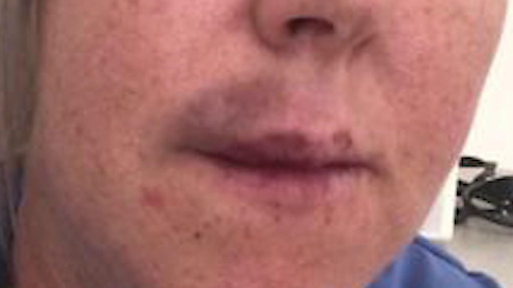 Plan to regulate ‘wild west’ beauty filler industry