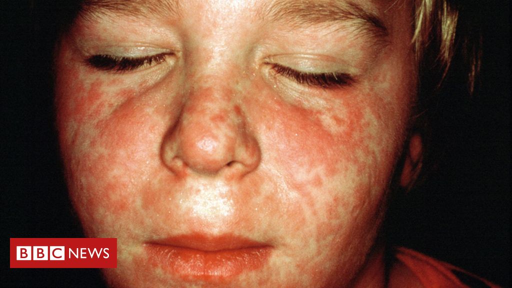 Measles resurgence fear amid coronavirus