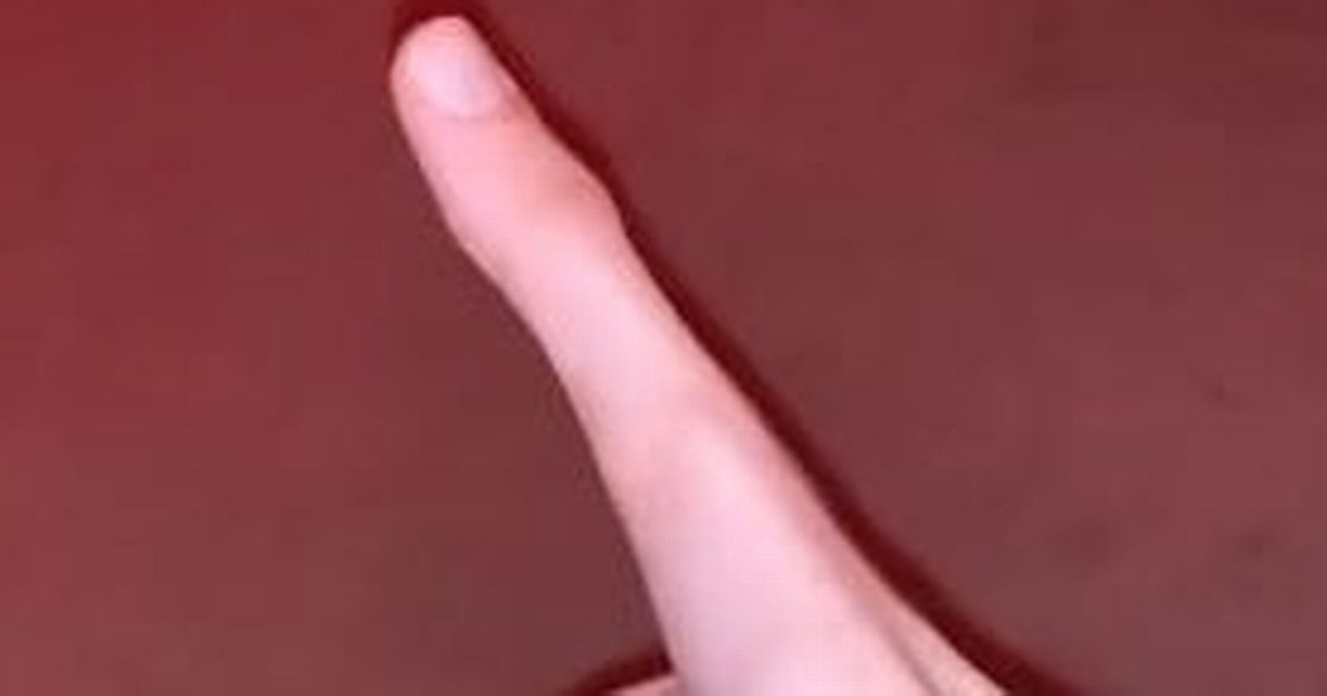 Lad has giant ‘E.T’ thumb that he can extend to 5.5 inches long which ‘regrows’