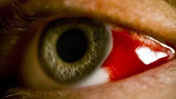 Deadly eye-bleeding virus found in France 'could make its way to UK'