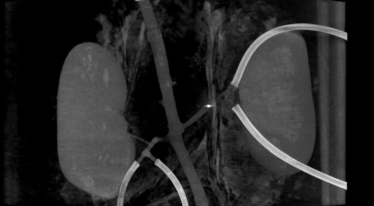 How tiny corkscrew robots could save lives by breaking up blood clots