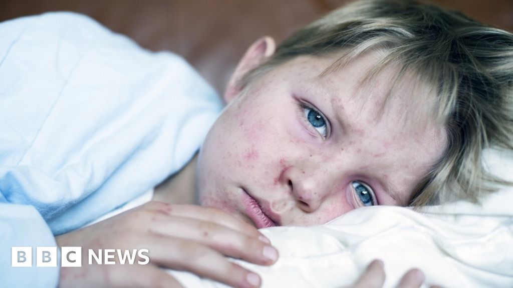 Alarming 45-fold rise in measles in Europe – WHO