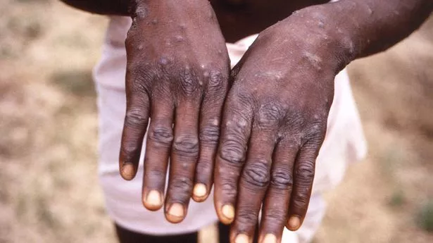 New monkeypox strain has chilling 'pandemic potential' scientists fear