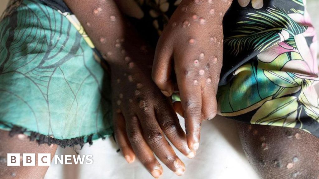 Mpox: Travellers advised to consider vaccine