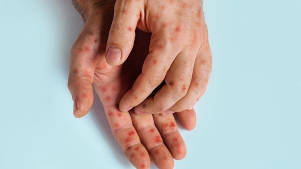 Panicked experts worried by 'really fast' spread of monkeypox virus that's gathering pace