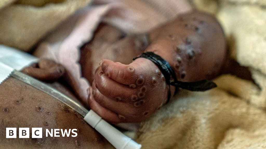 Mpox in DR Congo: Medics plead for vaccines as rate of infections increases