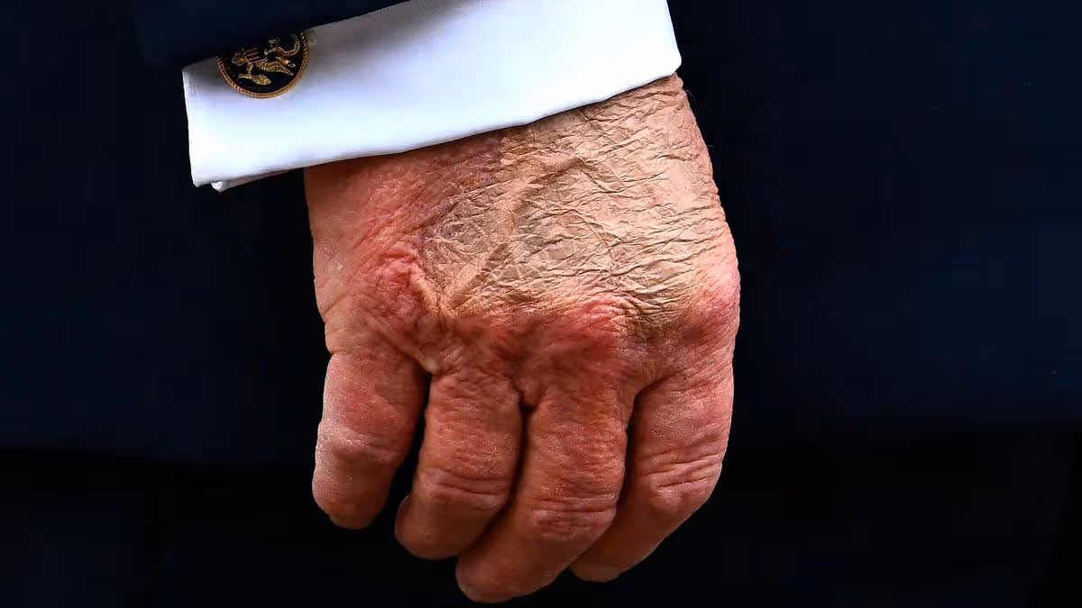 Concern for Donald Trump as he’s seen with ‘discoloured’ hand hours before medical exam